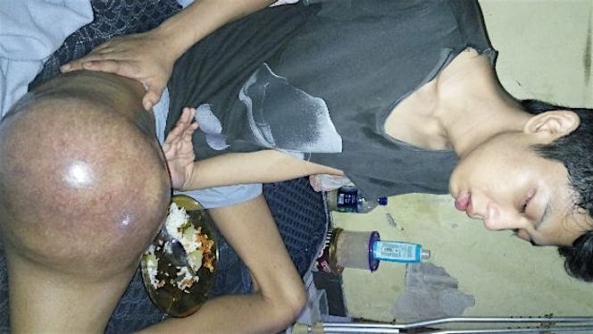 Bantu Febry Lawan Tumor Tulang Kaki