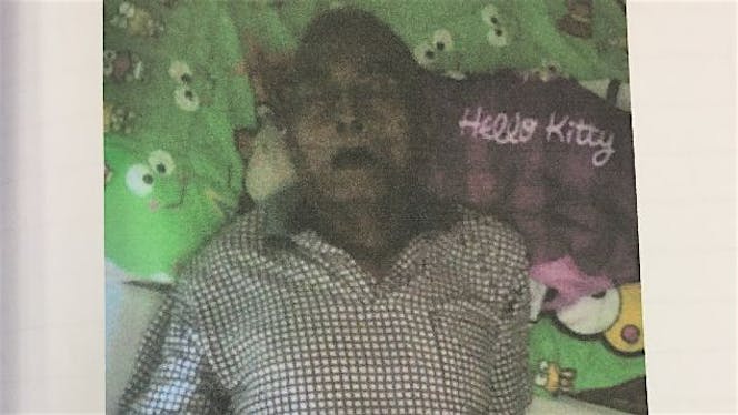 Mudahkan Pak Marno Melawan Batu Empedu
