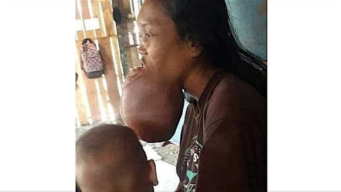 Bantu Sukinem melawan tumor mulut