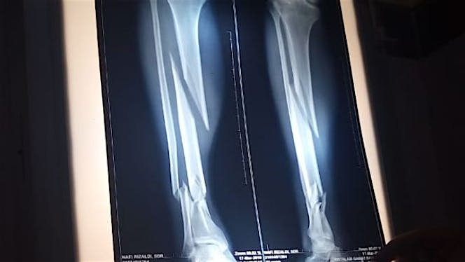 Bantu nafi' menyambung patah tulang kaki kanannya