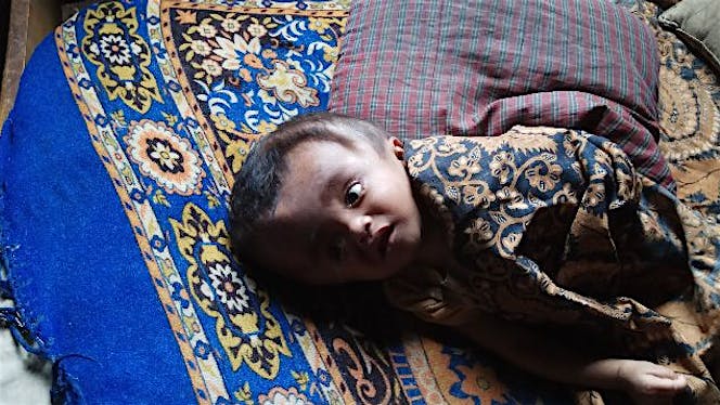 Bantu Bahar Penderita Hidrosepalouse untuk operasi