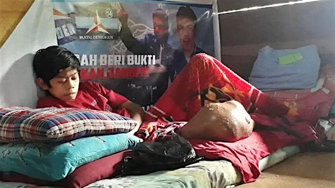 Bantu Fadly Tana Toraja Sulsel Lawan Tumor Ganas