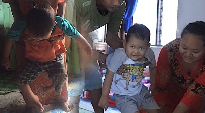 Terlahir Dengan 2 Kelainan dan Kaki Pengkor