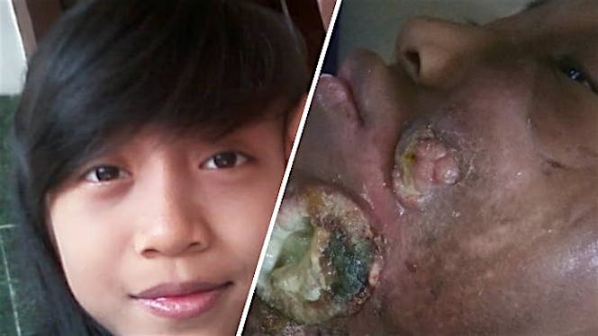 Bantu Dhina Sembuh Dari Kanker