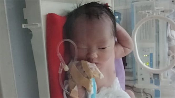 Bantu Bayi Delisha, Penderita Omfalokel