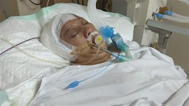 Bantu Ibuku Melawan Pembengkakan Syaraf Pada Otak
