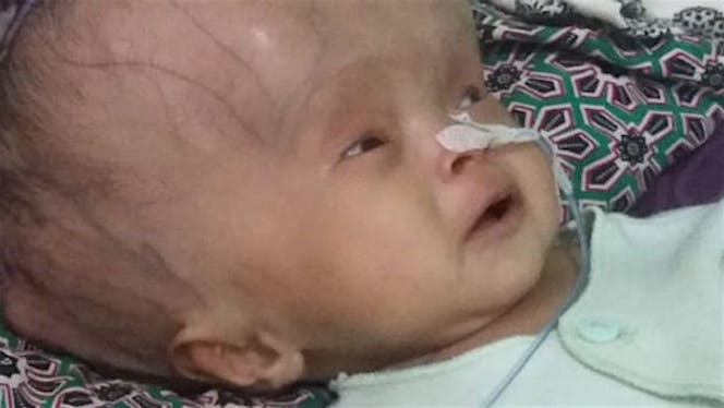 Bantu Eriana sembuh dari hydranencephaly