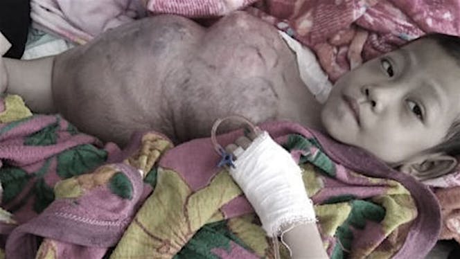 Bantu Riyandi Melawan Kanker Tulang (Osteosarcoma)
