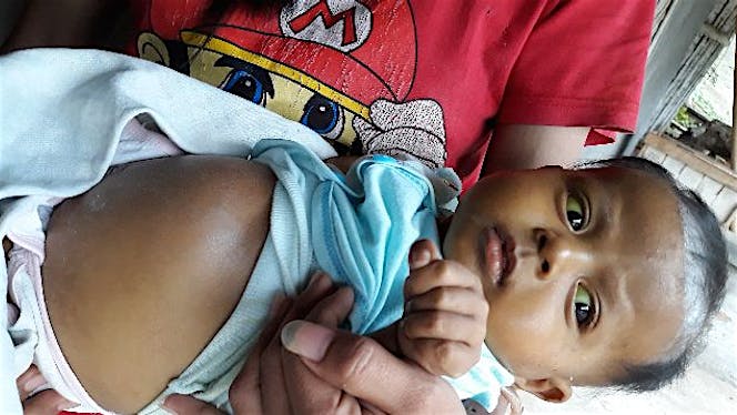 Bantu Felisia Lawan Atresia Bilier
