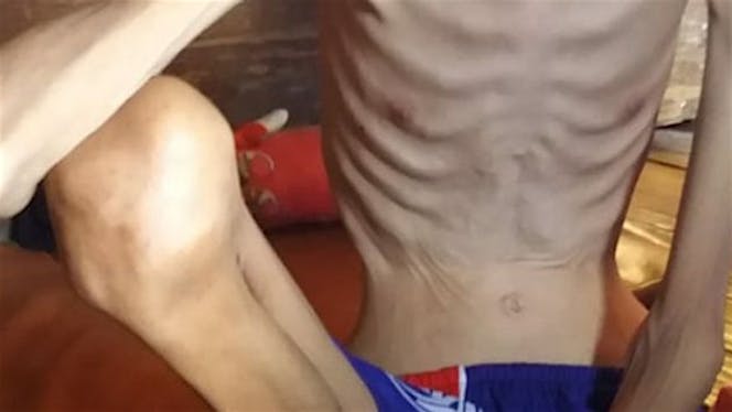 Bantu Boby andika melawan penyakit yg di deritanya