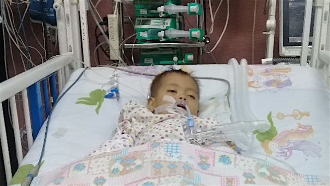 Bantu Abid down syndrome jantung bocor ASD multipe