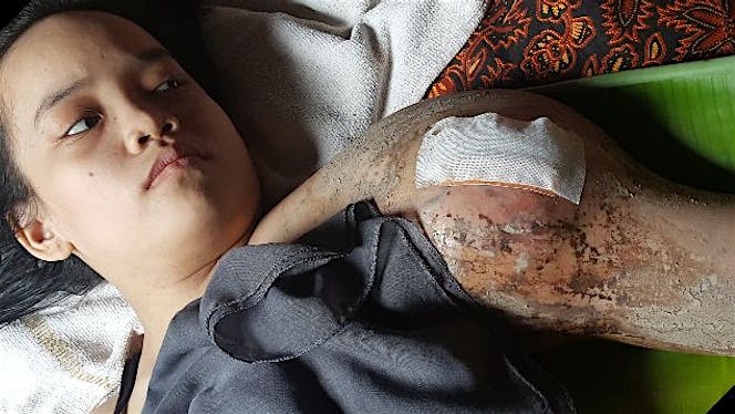 Bantu nilam melawan kanker tulang