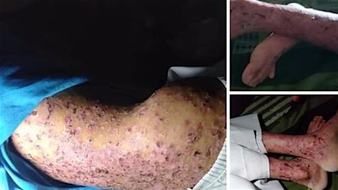 Bantu Amin berjuang melawan Epidermia Bullosa