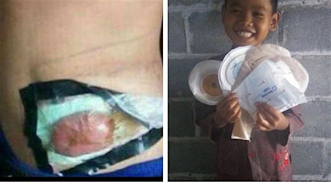 Gerakan 1000 kantong stoma