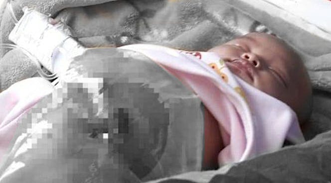 Alami Atresia Ani, Bantu Aliza untuk Operasi