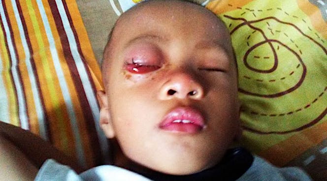 Gibran Ingin Sembuh Dari Tumor Mata