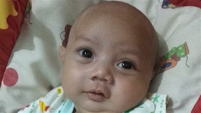 Bantu Idris Penderita Pierre Robin Sequence