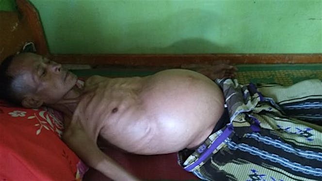 Bantu Mang Tolib Melawan Penyakit LIVER