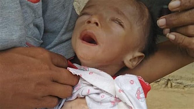 Bantu I Nengah Pait Dari Gizi Buruk